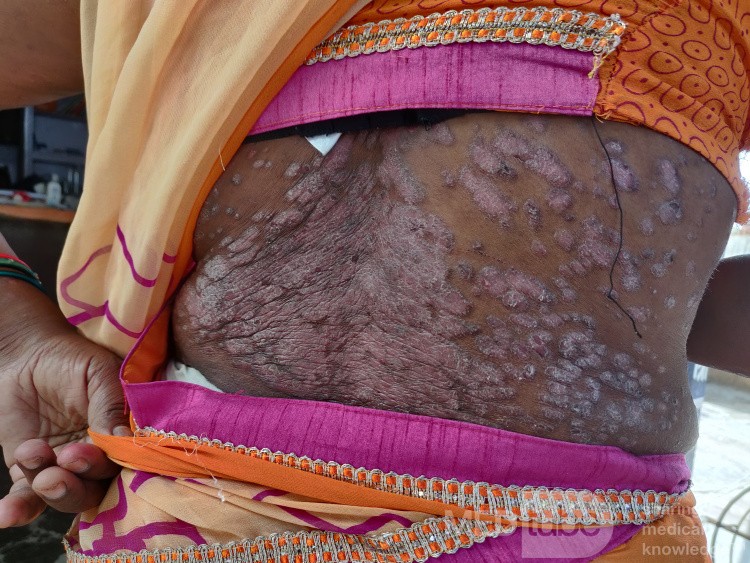 Atopic Dermatitis