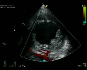 Left Ventricule Non Compaction