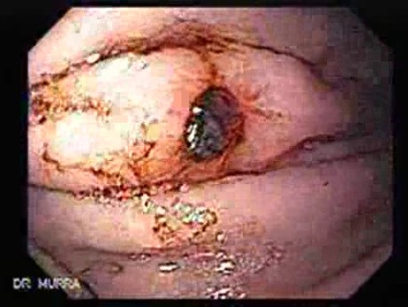 Dieulafoy´s Lesion (Exulceratio Simplex) (2 of 9)