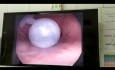 Intragastric Balloon Insertion for Morbid Obesity in Young Woman