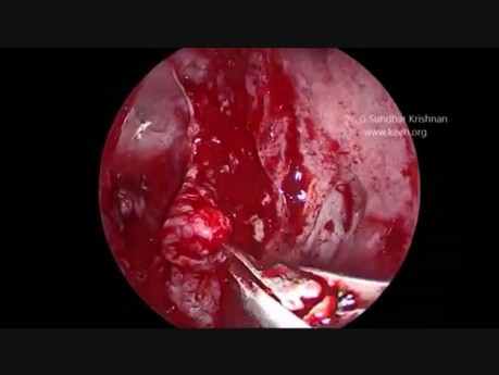 Meningoencephalocele