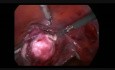 Lap Myomectomy with Uterin Arteries Ligation