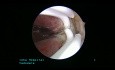 Hysteroscopic Resection on Complete Intrauterine Septal Upto Internal OS 