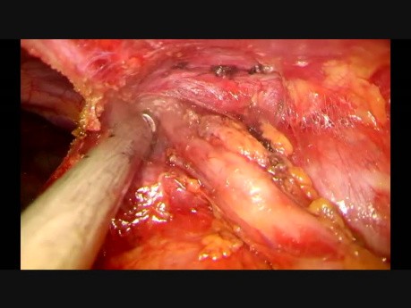 Subxiphoid Uniportal video-assisted thoracoscopic total thymectomy