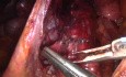 Laparoscopic Transperitoneal Para-aortic Lymphadenectomy