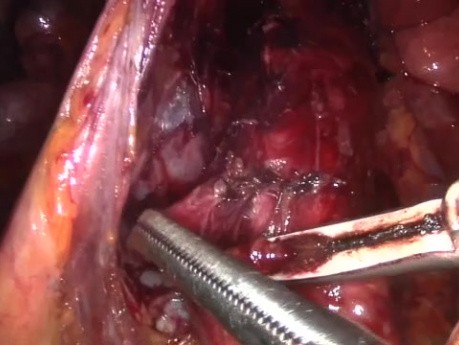 Laparoscopic Transperitoneal Para-aortic Lymphadenectomy