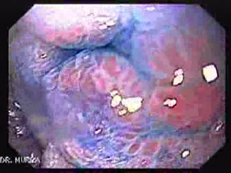 Pre - Pyloric Ulcer - Endoscopy (5 of 9)
