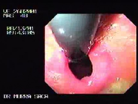 Duodenal Bulb - Retroflexed Maneuver