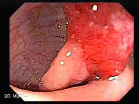 Colonoscopic Polypectomy (4 of 23)