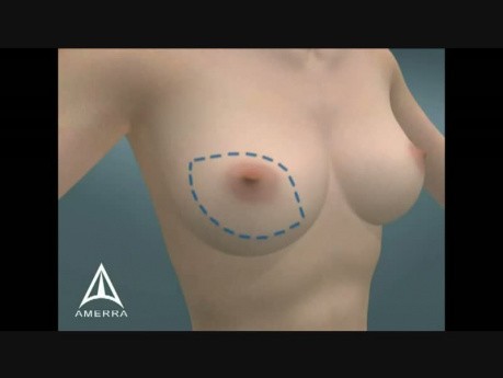 Modified Radical Mastectomy - 3D Medical Animation