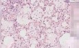 Bronchioloalveolar carcinoma - Histopathology - Lung, lymph node