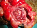 Multiple Rectal Ulcers (73 of 110)