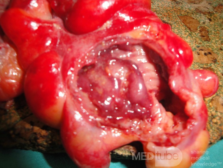 Multiple Rectal Ulcers (73 of 110)