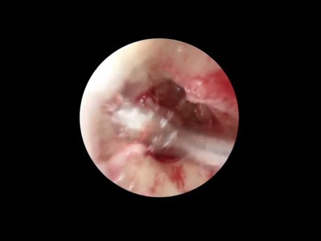 Endoscopic Tympanoplasty for Tympanosclerosis