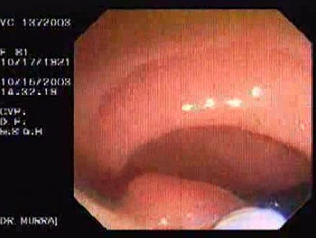 Tubulo - Villous Adenoma - Endoscopy (12 of 28)