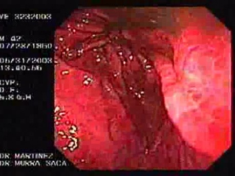 Hourglass Stomach - Constriction at the Proximal Gastric Corpus - Assessment of the Antrum