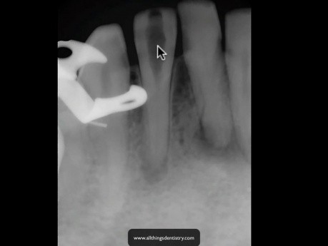 Calcified Incisor - How To Read A Near Miss Radiograph