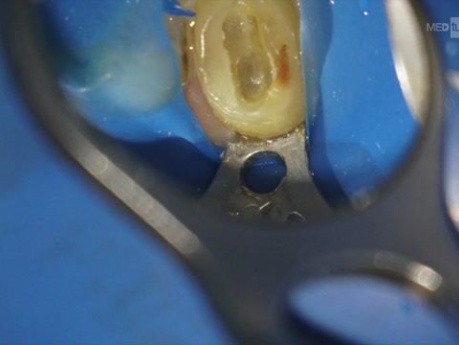 Calcification Opening with EDM