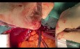 Off Pump Pulmonary Embolectomy a New Paradigm in CV Surgery