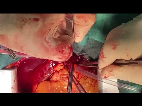 Off Pump Pulmonary Embolectomy a New Paradigm in CV Surgery