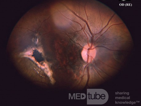 Traumatic Choroidal Rupture