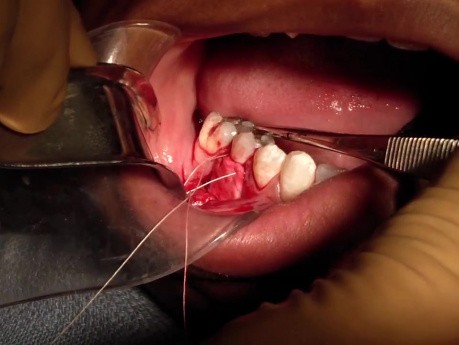 Part 5/8: Root Coverage Surgery - Mandibular Premolar - Keep That In Place