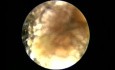 Synechia In External Ear Canal Post Mastoidectomy
