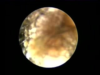 Synechia In External Ear Canal Post Mastoidectomy