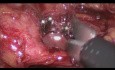 Laparoscopic Cholecystectomy