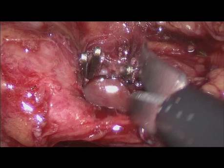 Laparoscopic Cholecystectomy