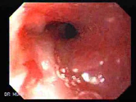 Esophageal Stricture Due To Reflux Esophagitis - Reduction Of The Diameter Of The Gastroesophageal Junction