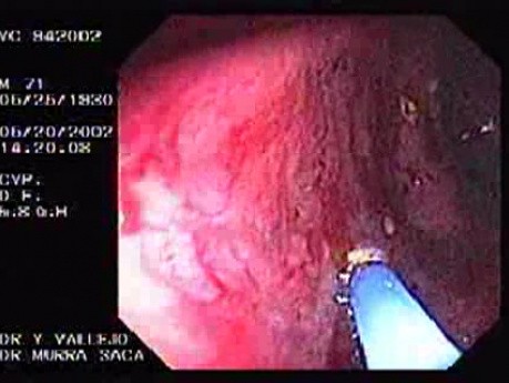 Radiation Proctosigmoiditis (5 of 14)