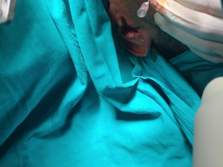 Introral Reduction of Zygomatic Arch