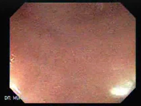 Gastrointestinal Stromal Tumour of the Rectum (3 of 3)