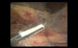 Laparoscopic Anterior Resection for Rectosigmoid Colon Cancer (full video)