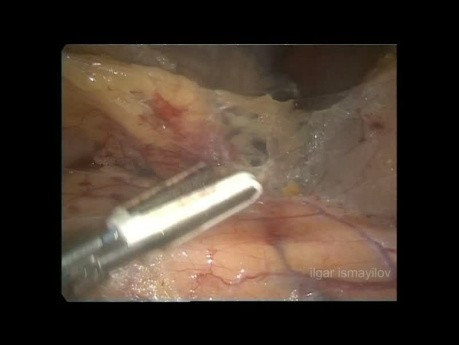 Laparoscopic Anterior Resection for Rectosigmoid Colon Cancer (full video)