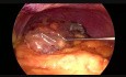 Minilaparoscopic Clipless Left Adrenalectomy + Cholecystectomy + Unroofing Hepatic Cyst
