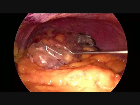 Minilaparoscopic Clipless Left Adrenalectomy + Cholecystectomy + Unroofing Hepatic Cyst