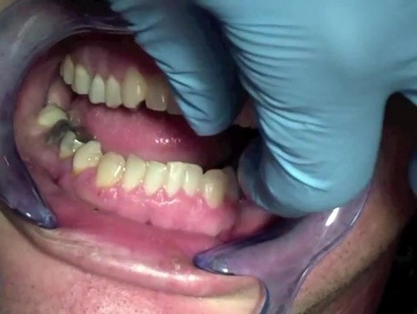 Mandible Fracture - Movement