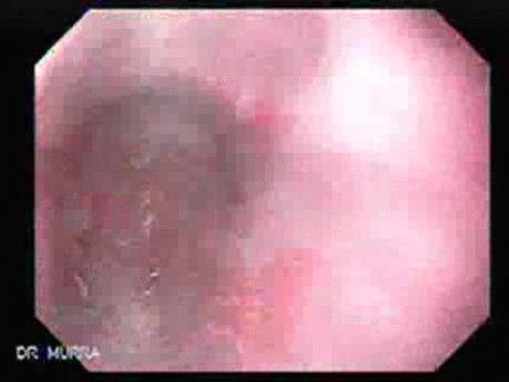 Barrett's Esophagus of long segment -GERD (3 of 11)