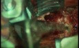 Cervical Solitary Plasmocytoma - Vertebrectomy And Arthrodesis Anterior Route