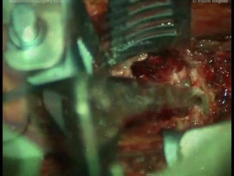 Cervical Solitary Plasmocytoma - Vertebrectomy And Arthrodesis Anterior Route