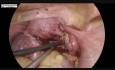 Laparoscopic Myomectomy for Posterior Wall Fibroid Uterus with Endometriosis