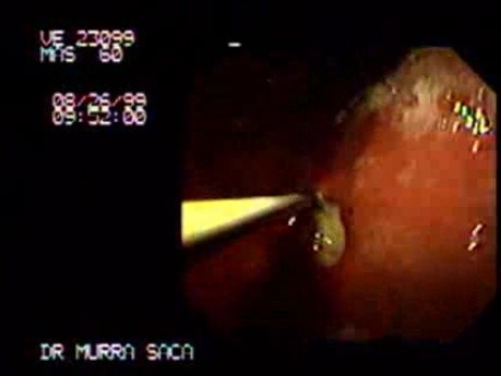 Ulcer Scars (2 of 2)