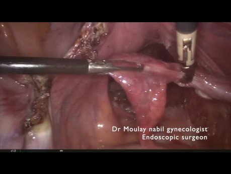 Sacrocolpopexy for Genitourinary Prolapse - Tips and Tricks