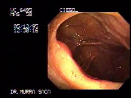 Cecum