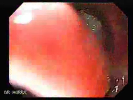Squamous cell carcinoma of the larynx (2 of 3)