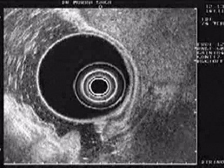 Endoscopic Ultrasound (EUS) of Gastric Body (2 of 2)