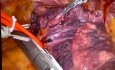 Robotic Stapler For Left Upper Lobectomy