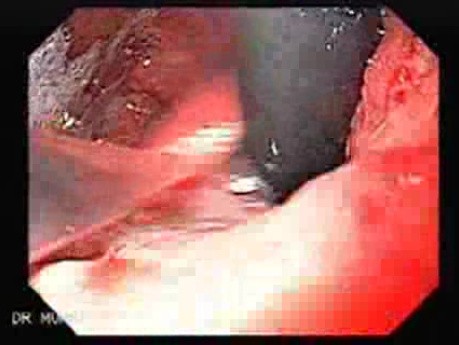 Scirrhous Gastric Carcinoma - Endoscopy (4 of 47)